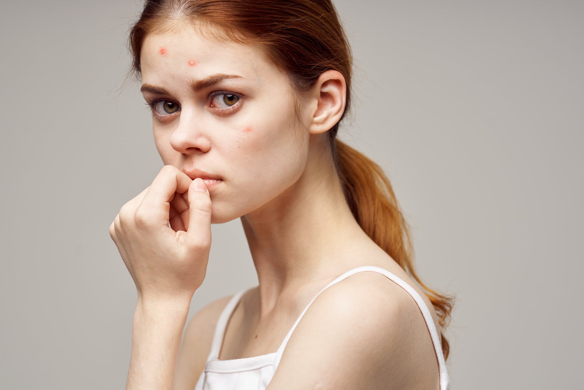 Is Your Acne a Sign of Hormonal Imbalance? Averr Aglow