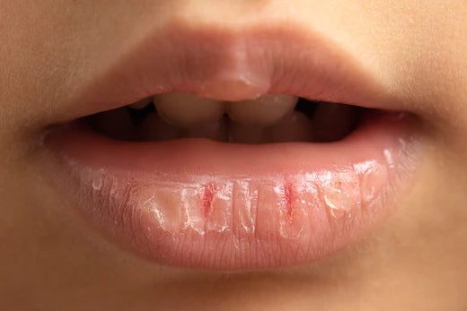 Chapped Lips: Rescue Your Pout | Averr Aglow Chapped Lips: Rescue Your Pout | Averr Aglow