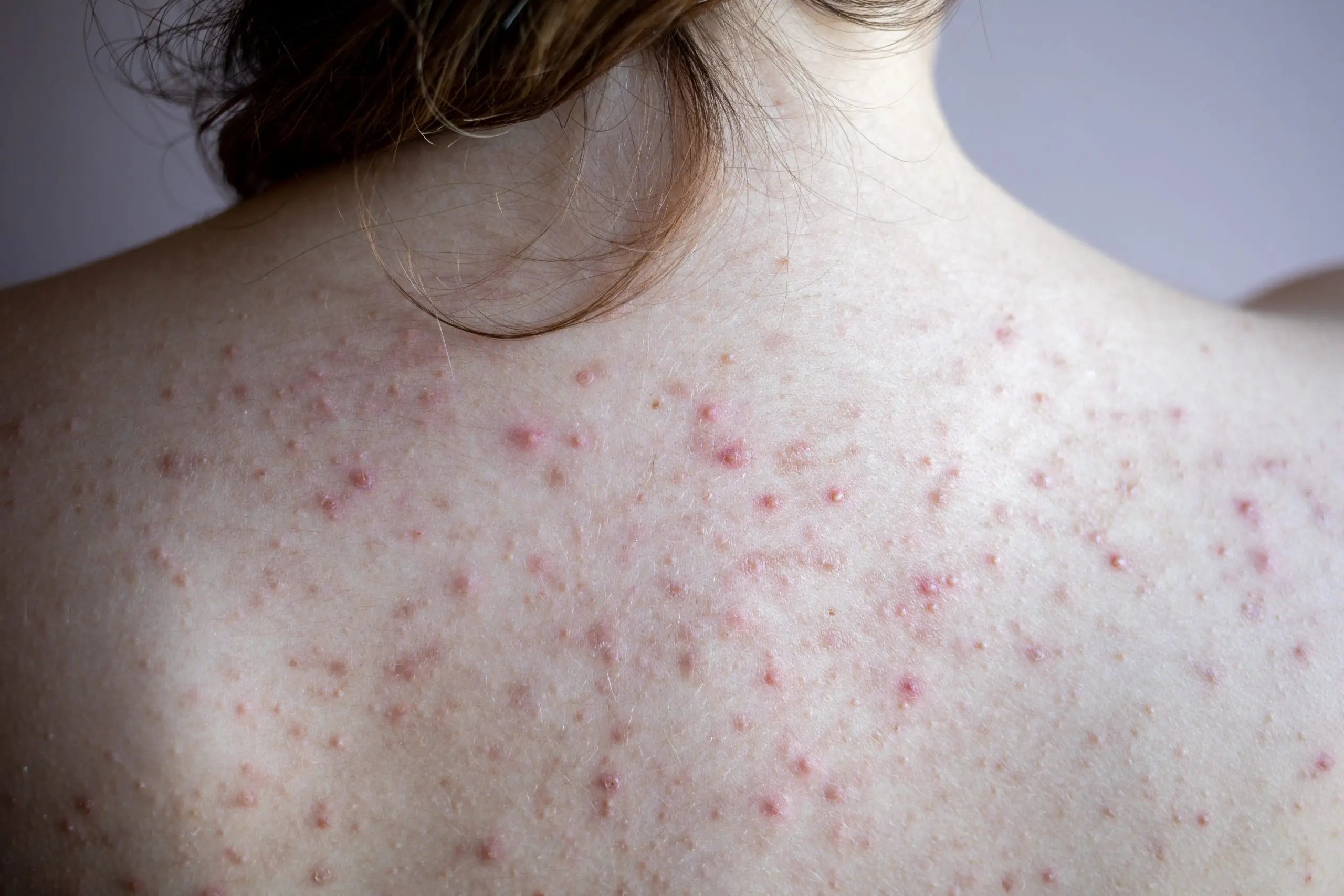 Back Acne: A Guide to Clearer Skin Averr Aglow