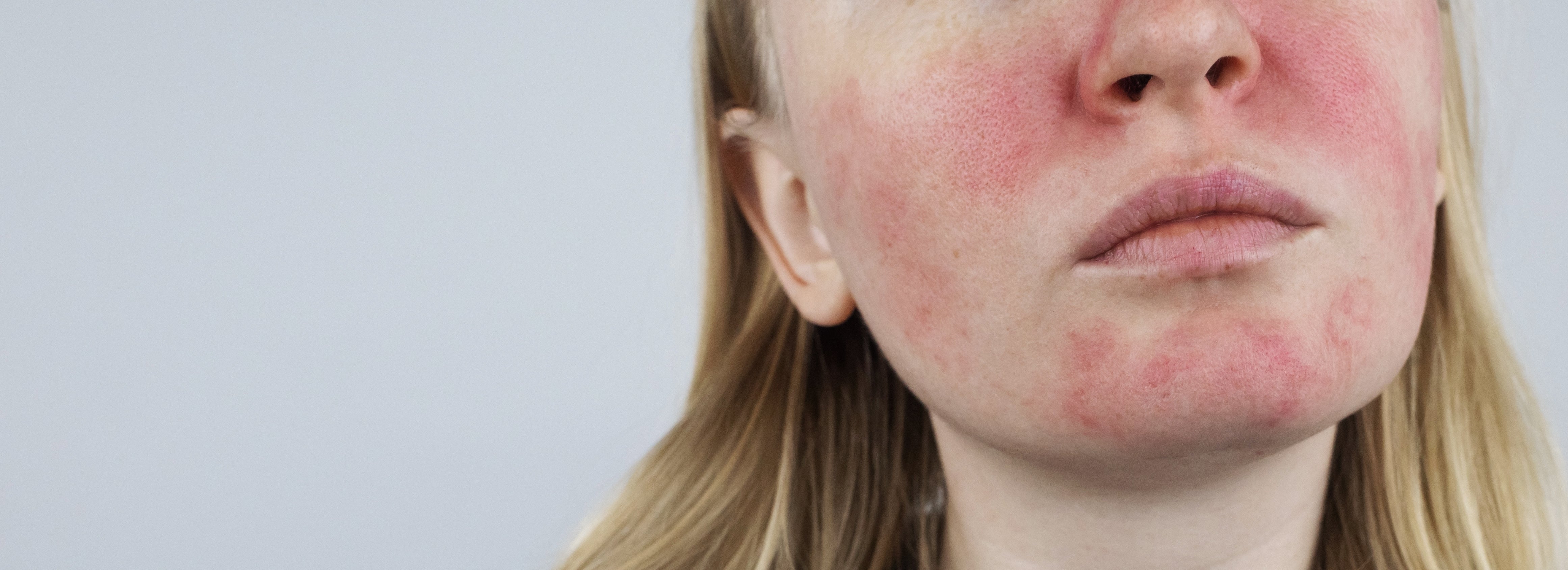 Rosacea Treatment: Causes, Symptoms, and Skincare Averr Aglow