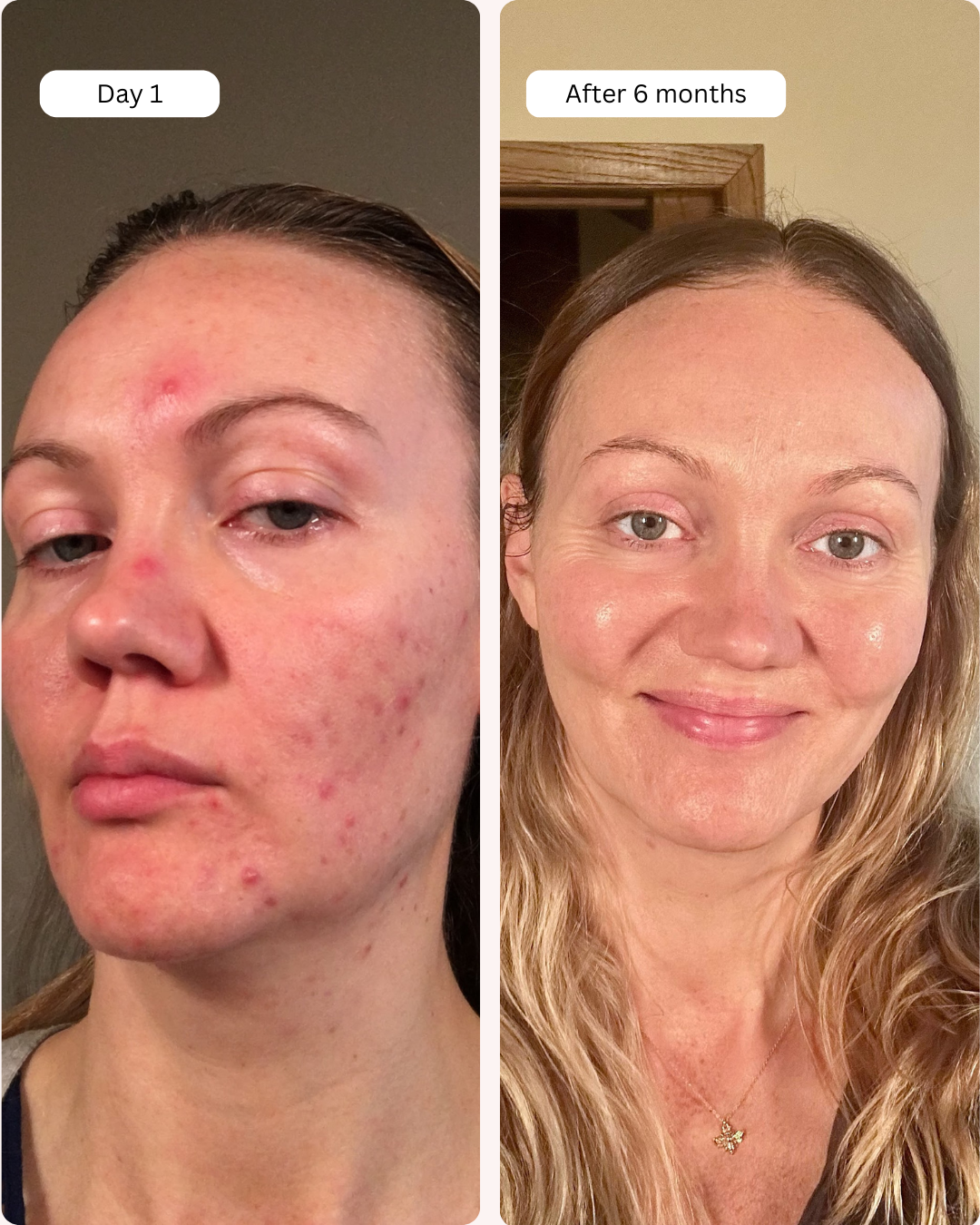 (Black Friday Special) Clear Skin Bundle