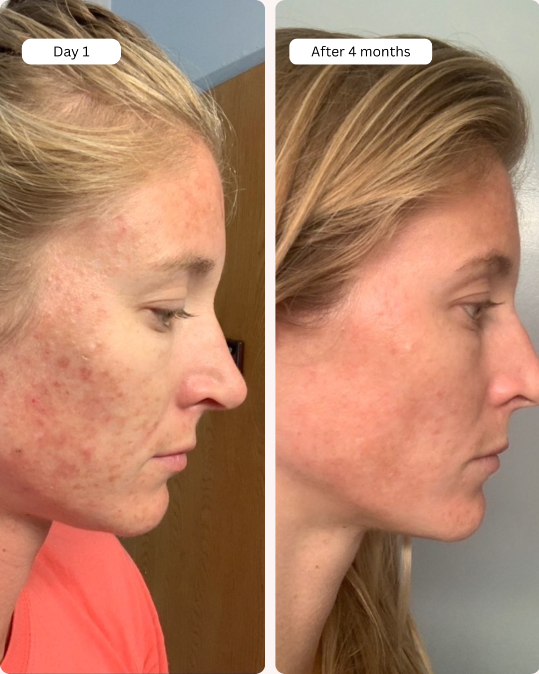 (Black Friday Special) Clear Skin Bundle