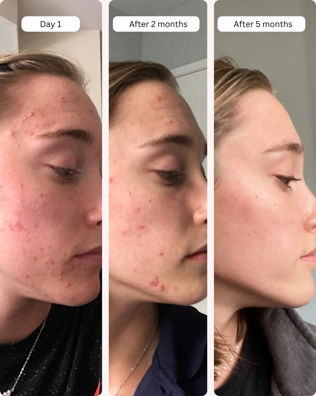 (Black Friday Special) Clear Skin Bundle