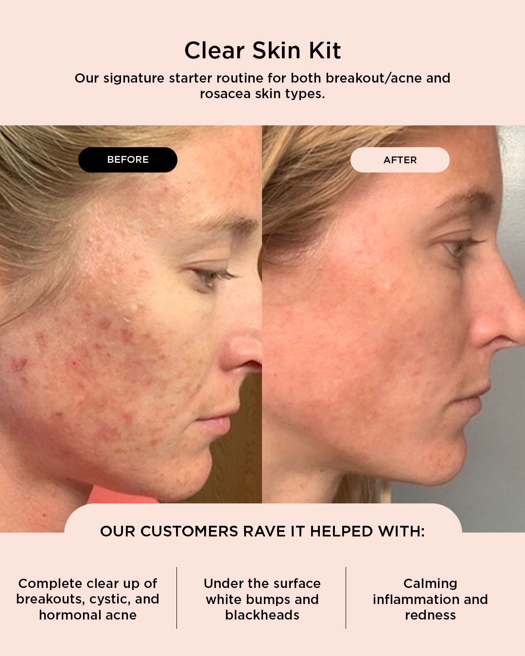 (Black Friday Special) Clear Skin Bundle