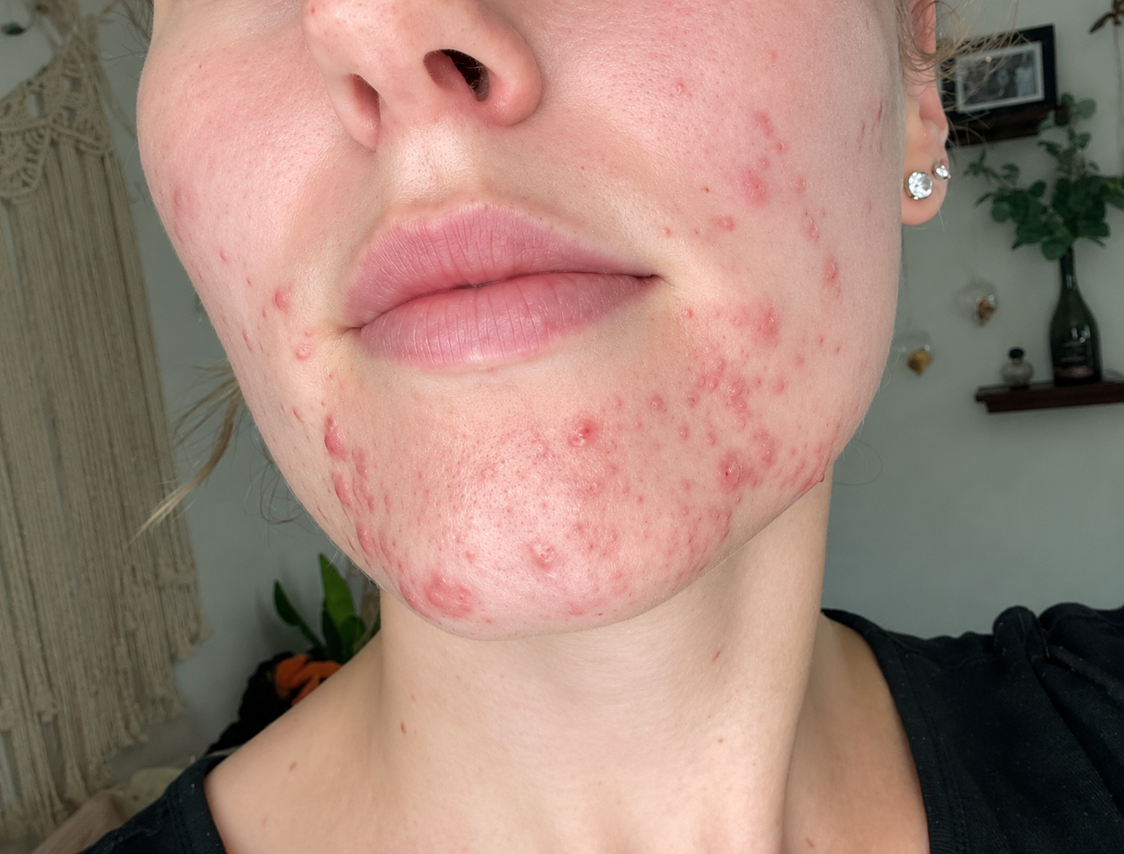 Four Things You Don't
Want to Lose Sight of
While You're Clearing Your
Breakouts.