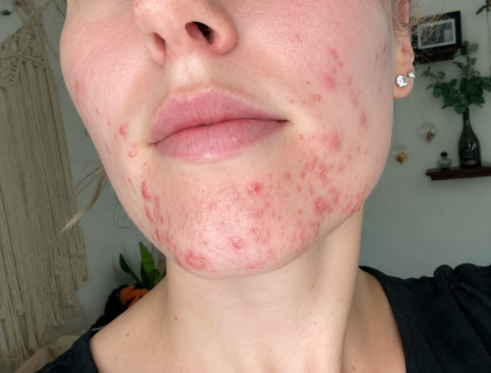 Hormonal Acne