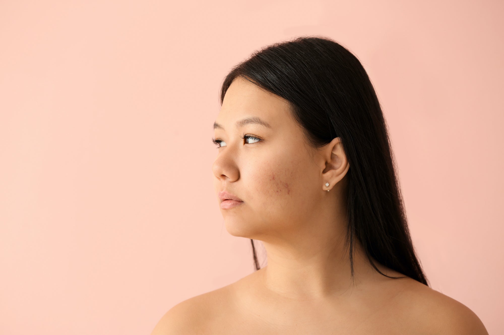 What’s the Deal With Hormonal Cystic Acne?