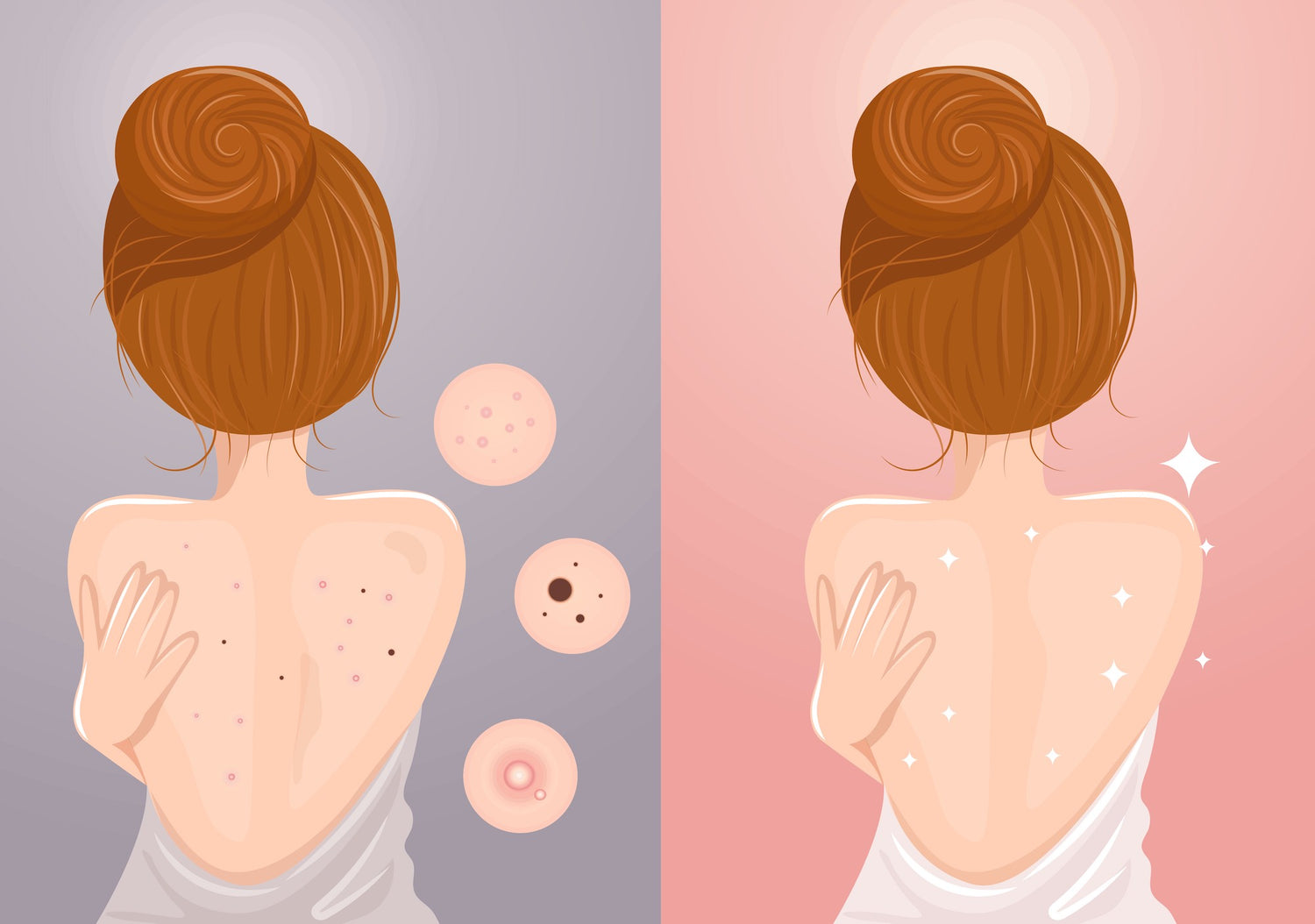 How to Stop Back Acne Scars For Good