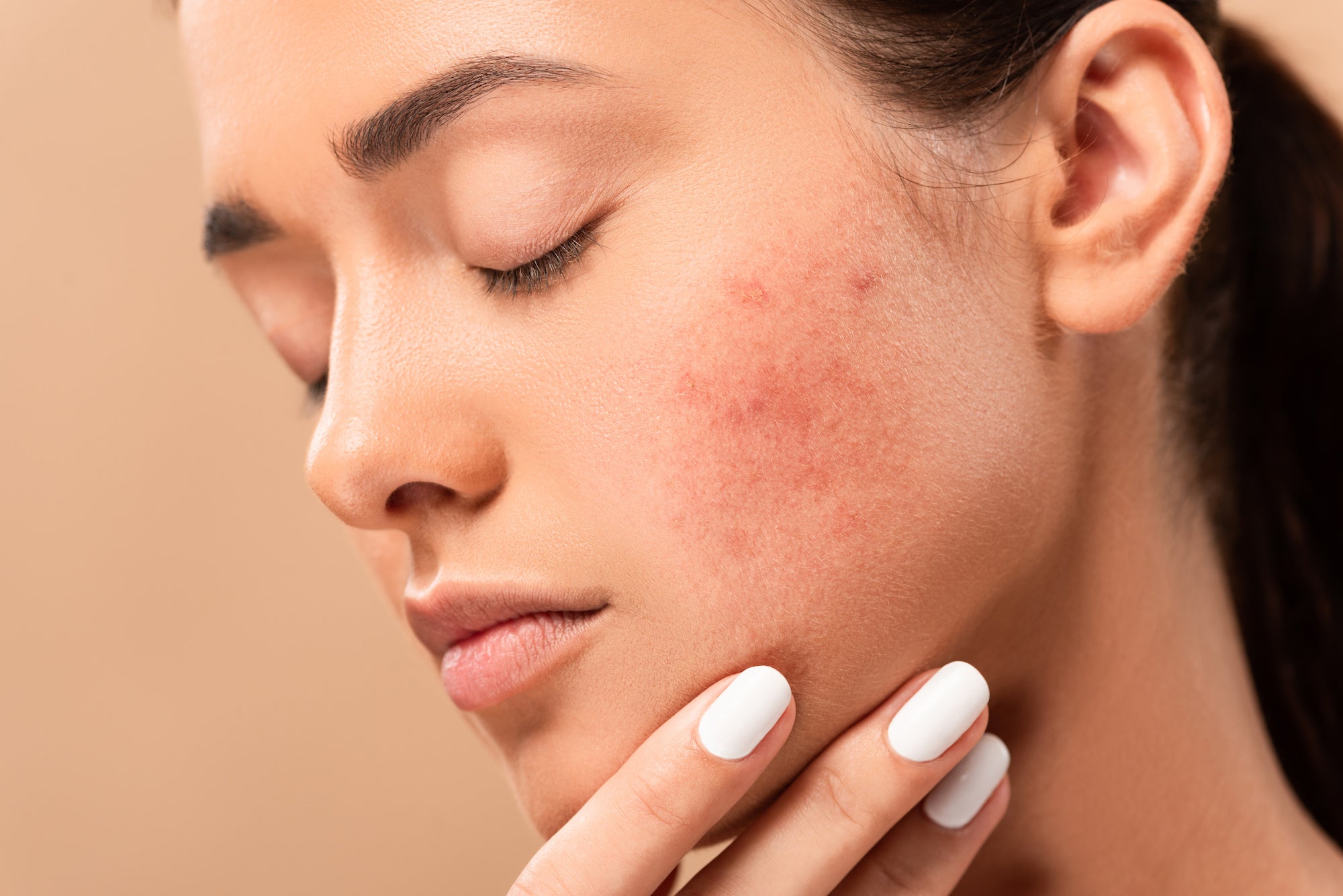 The 6 Mistakes Causing Your Acne Scars