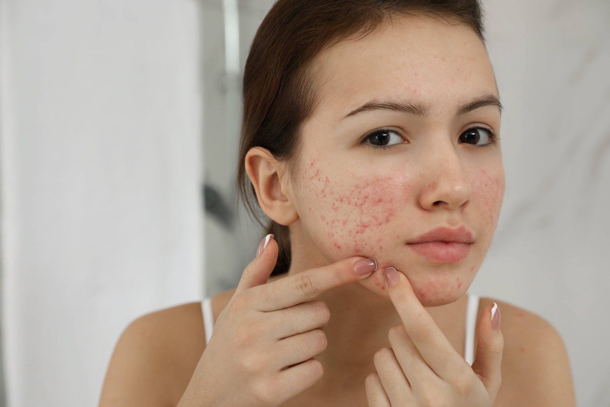 5 Types of Acne Scars - and Why You Should Care Averr Aglow