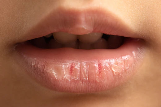 Chapped Lips: Rescue Your Pout Averr Aglow