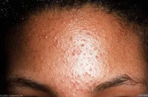 Understanding Fungal Acne Causes Averr Aglow
