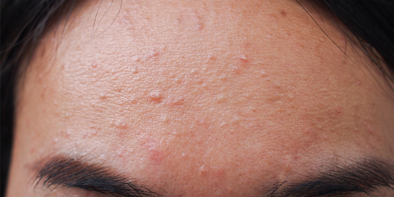 Fungal Acne: An In-Depth Exploration Averr Aglow