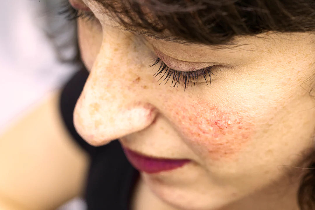 Dealing With Rosacea: Causes, Symptoms, Treatments, and Skincare Tips Averr Aglow