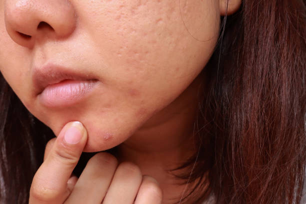 Pustules: Effective Strategies for Clear Skin Averr Aglow