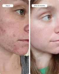 Clear Skin Kit & Perfectionist Serum