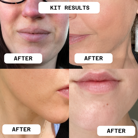 The Clear Skin Kit
