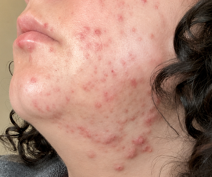Cystic Breakouts