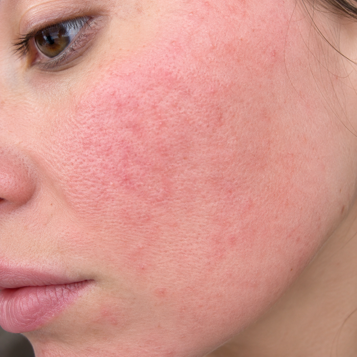 Inflamed & Sensitive Skin